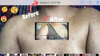 HOW TO GET RID OF SEVERE ACNE DARK SPOTS amp HYPERPIGMENTATION FAST  LIVE DEMO  NO CLICK BAIT [upl. by Josselyn]