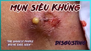 Big Cystic Acne Blackheads Extraction Blackheads amp Milia Whiteheads Removal Pimple Popping [upl. by Nylg]