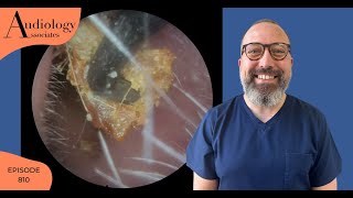 EAR WAX REMOVAL COMPILATION INC PSORIASIS SKIN REMOVAL EP810 [upl. by Arivle442]