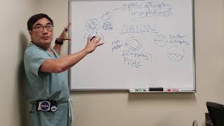 Optic Atrophy  Disc Morphology [upl. by Garlen]