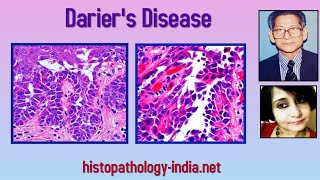 Pathology of Dariers Disease  Dr Sampurna Roy MD dermpath dermatopathology [upl. by Faunie]