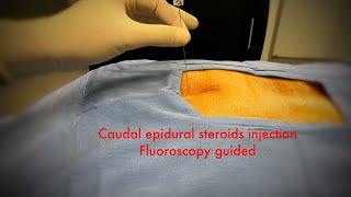 caudal epidural steroids injection fluoroscopystep by step [upl. by Farrington631]