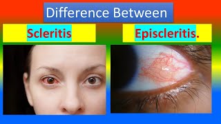 Difference between Scleritis and Episcleritis [upl. by Kcirdla]