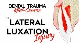 Dental Trauma MiniCourse  Part 9  Dental Trauma Guide  The Lateral Luxation Injury [upl. by Nehtiek187]