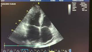 Posterior mitral valve leaflet chordae rupture with severe mitral regurgitation 2 [upl. by Taam]