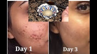 aspirin for acne before and after  how to get rid of acne in 3 days use aspirin [upl. by Aleacim]