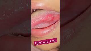 Aphthous Ulcer spotdiagnosis [upl. by Yrro]