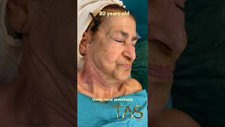 80 yearsold doctor has a scarless facelift under local anesthesia profdrsuleymantas [upl. by February]