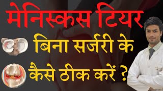 मेनिस्कस टियर का बिना सर्जरी के इलाज कैसे करें  Heal your Meniscus Tear without Surgery [upl. by Anatnahs]