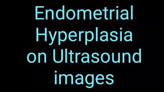 Endometrial Hyperplasia on Ultrasound Imaging [upl. by Deedee]