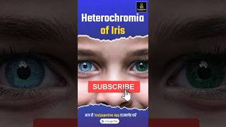 heterochromia of iris  Different Colored Eyes heterochromia eyes ophthalmology testpaperlive [upl. by Antoinetta]