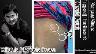 What is Pityriasis RoseaHerpes VirusHerald PatchTypes and Treatment in Hindi [upl. by Wrand]