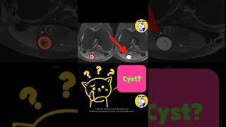 Fig 4D19 Schwannoma [upl. by Leahcin]