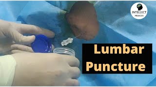 Lumbar Puncture Procedure in just 11 mins [upl. by Elocal572]