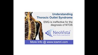 Thoracic Outlet Syndrome and EMG Part 1 [upl. by Jeffry869]