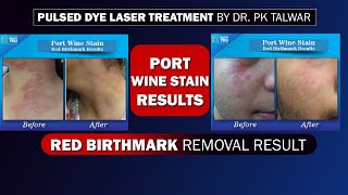 Port Wine Stain Before After Results Red Birthmark Result with Pulsed Dye Laser Treatment [upl. by Ardek19]