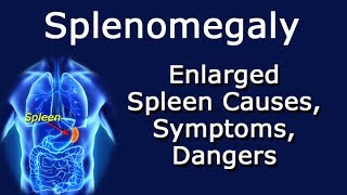 Splenomegaly Enlarged Spleen Causes Symptoms Dangers [upl. by Longawa798]