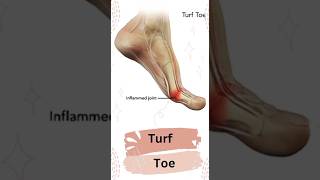 Turf toe injury  🤔what do u mean by that turftoe anatomy condition injury orthopedics bigtoe [upl. by Elodie]