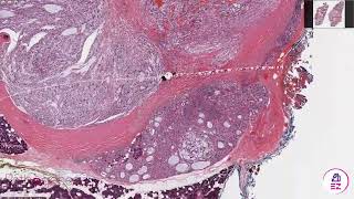 Epithelial Myoepithelial Carcinoma [upl. by Charpentier649]