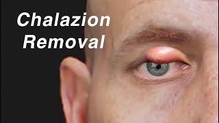 Chalazion Eyelid Cyst Removal Animation [upl. by Kasevich]