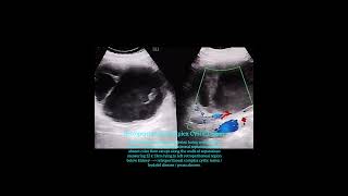 Retroperitoneal complex cystic lesion  hydatid disease  abscess [upl. by Aneerhs]