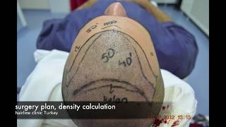 Hair Transplant Turkey REPAIR HAIR TRANSPLANT FUE 3340 GRAFTS [upl. by Tana]