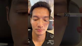 Botox for Men Brotox botox botoxinjections botoxfillers [upl. by Yevol688]