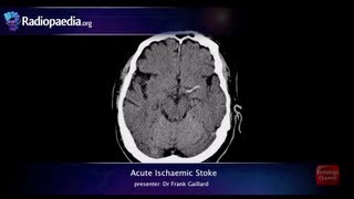 Stroke Acute infarction  radiology video tutorial CT MRI angiography [upl. by Adnic]