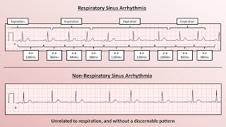 Advanced EKGs  Sinus Node Dysfunction [upl. by Sokin]