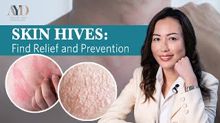 Skin Hives Find Relief and Prevention [upl. by Nwahsar324]