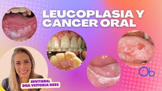 Leucoplasia y Cáncer Oral 👄 con Dra Victoria Rees [upl. by Eetnahs453]