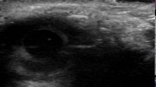 Ultrasound exam of pupillary response [upl. by Anecusa]