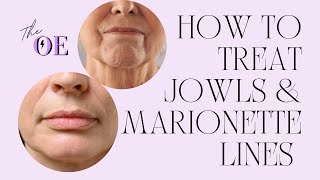 How To Treat Jowls amp Marionette Lines At Home [upl. by Doownil]