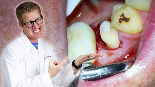 Every Cause of TOOTH PAIN AFTER CROWNS amp TEMPORARY CROWNS Why It Hurts Years Later or Comes amp Goes [upl. by Hoenack]