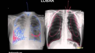 Pneumonia Imaging [upl. by Yrotciv932]