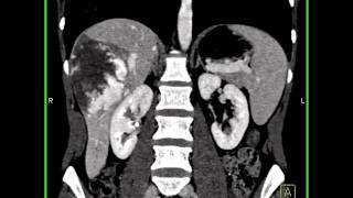 Abdomen Liver Cavernous Hemangioma of the Liver6 of 9 [upl. by Dylana]