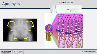 Hip and Pelvis Apophysitis [upl. by Yneffit]