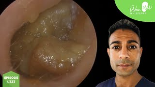 1323  Huge Chunks of Ear Wax Removed [upl. by Rockafellow]