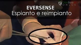 EVERSENSE  Il sensore sottopelle Espianto e reimpianto nello stesso sito [upl. by Winona]