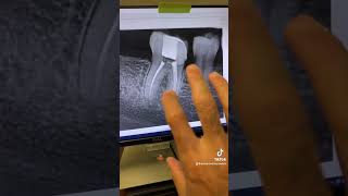 Root canal therapy of tooth 30 [upl. by Yrrehs]