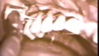 Osseous Surgery in the Maxilla [upl. by Elleryt729]