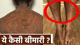 Ichthyosis vulgaris Disease क्या है Symptoms Reason Treatment । Boldsky Health [upl. by Ahsetan]