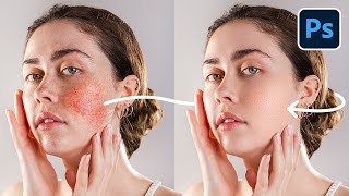 ERASE Blotchy Skin with HighEnd Retouching Trick  Photoshop Tutorial [upl. by Concha284]