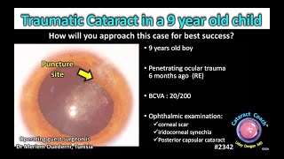 CataractCoach™ 2342 traumatic cataract in a 9 year old child [upl. by Iznik698]