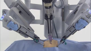 da Vinci® Robotic Surgical System [upl. by Favian]