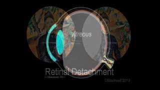 Retinal Detachment [upl. by Parrnell]