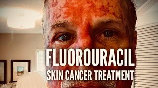 Fluorouracil Skin Treatment  Before During and After [upl. by Terag]