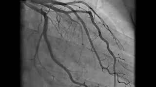 Coronary Angiography  NEJM [upl. by Rosanna983]