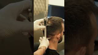 HAIR TRANPLANT TURKEY  MEDART HAIR ISTANBUL  hairtransplantbeforeafter [upl. by Lapides]