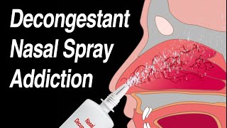 Decongestant Nasal Spray Addiction Afrin Zicam Sinex NeoSynephrine etc [upl. by Husain]